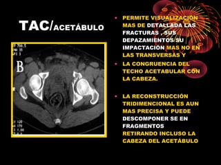 TAC/ACETÁBULO
• PERMITE VISUALIZACIÓN
MAS DE DETALLADA LAS
FRACTURAS , SUS
DEPAZAMIENTOS SU
IMPACTACIÓN MAS NO EN
LAS TRANSVERSAS Y
• LA CONGRUENCIA DEL
TECHO ACETABULAR CON
LA CABEZA.
• LA RECONSTRUCCIÓN
TRIDIMENCIONAL ES AUN
MAS PRECISA Y PUEDE
DESCOMPONER SE EN
FRAGMENTOS
RETIRANDO INCLUSO LA
CABEZA DEL ACETÁBULO
 