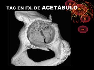 TAC EN FX. DE ACETÁBULO
 