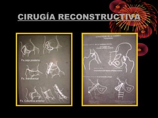 CIRUGÍA RECONSTRUCTIVA
Fx.ceja posterio
Fx. transversal
Fx. Columna anterior
 