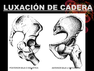 LUXACIÓN DE CADERA
POSTERIOR BAJA O ISQUIÁTICA ANTERIOR BAJA U OBTURATRIZ
 
