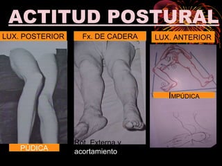 ACTITUD POSTURAL
LUX. POSTERIOR Fx. DE CADERA LUX. ANTERIOR
IMPÚDICA
PÚDICA
Rot. Externa y
acortamiento
 