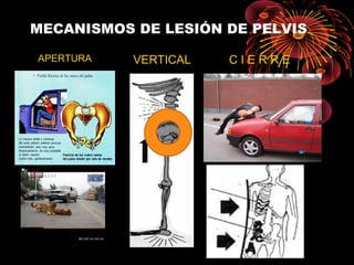 MECANISMOS DE LESIÓN DE PELVIS
APERTURA VERTICAL C I E R R E
 