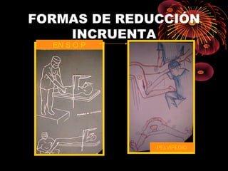 FORMAS DE REDUCCIÓN
INCRUENTA
PELVIPEDIO
EN S O P
 