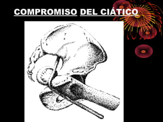 COMPROMISO DEL CIÁTICO
 