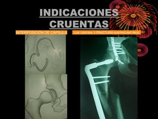 INDICACIONES
CRUENTAS
INTERPOSICIÓN DE CÁPSULA LUX. CENTRAL Y FRACTURA SUBTROCANT´RICA
 