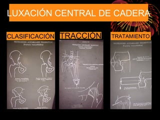 LUXACIÓN CENTRAL DE CADERA
CLASIFICACIÓN TRACCIÓN TRATAMIENTO
 