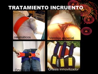 TRATAMIENTO INCRUENTO
neumáticos Vendaje especial
Ortesis de ajuste Ortesis inmovilizador
 