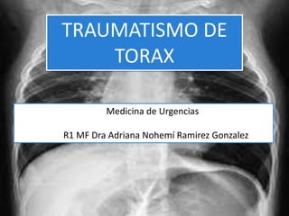 Traumatismo de torax
TRAUMATISMO DE
TORAX
Medicina de Urgencias
R1 MF Dra Adriana Nohemí Ramirez Gonzalez
 