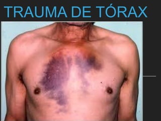 TRAUMA DE TÓRAX
 