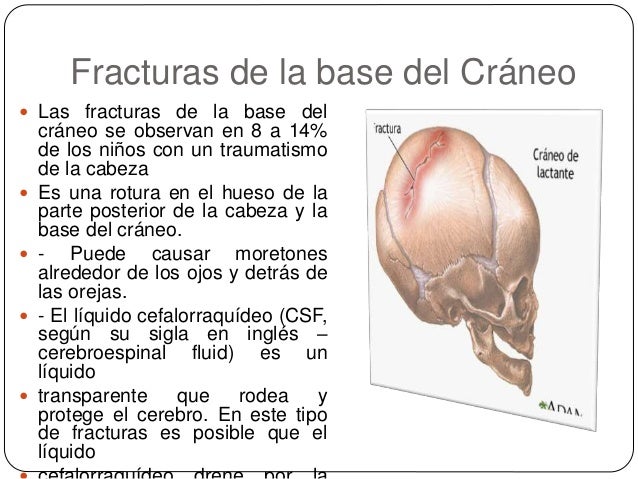 Trauma Encéfalo Craneal Pediatria