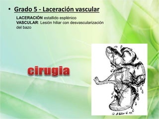 • Grado 5 - Laceración vascular
LACERACIÓN estallido esplénico
VASCULAR: Lesión hiliar con desvascularización
del bazo
 