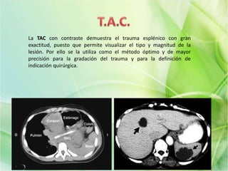 La TAC con contraste demuestra el trauma esplénico con gran
exactitud, puesto que permite visualizar el tipo y magnitud de la
lesión. Por ello se la utiliza como el método óptimo y de mayor
precisión para la gradación del trauma y para la definición de
indicación quirúrgica.
 
