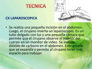 • Se realiza una pequeña incisión en el abdomen.
Luego, el cirujano inserta un laparoscopio. Es un
tubo delgado con luz y una pequeña cámara que
permite que el cirujano observe el interior del
cuerpo en un monitor de video. Se inyecta
dióxido de carbono en el abdomen. Esto genera
que se expanda y permite al cirujano tener más
espacio para trabajar.
 