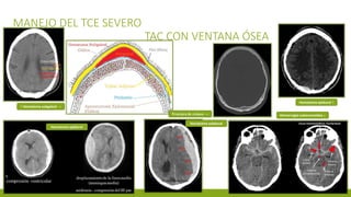 MANEJO DEL TCE SEVERO
TAC CON VENTANA ÓSEA
↑ Hematoma subgaleal →
Fractura de cráneo →
Hematoma epidural ↑
Hematoma epidural
Hematoma subdural
Hemorragia subaracnoidea ↓
 