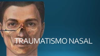 Traumatismo nasal