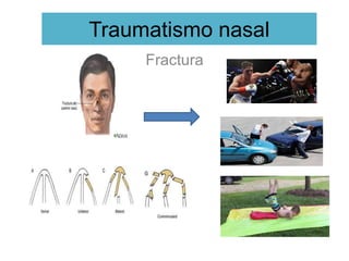 Traumatismo nasal
Fractura
 
