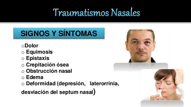 Traumatismo Nasal. Epistaxis Traumatismo Nasal. Epistaxis