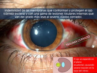 Indemnidad de las membranas que conforman y protegen el ojo (córnea-esclera) y con una gama de lesiones tisulares internas que van del grado más leve al severo, (Globo cerrado).TRAUMA CERRADOEl ojo se expande en el plano ecuatorial, causando severa tracción en la base del vítreo