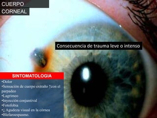 CUERPO EXTRAÑOCORNEALConsecuencia de trauma leve o intensoSINTOMATOLOGIADolor