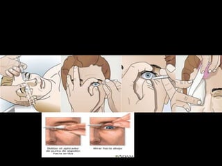 Sensación de cuerpo extraño ↑con el   parpadeo