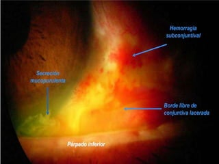Inyección conjuntival