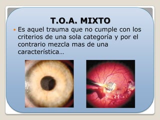 Desviación de la pupila 