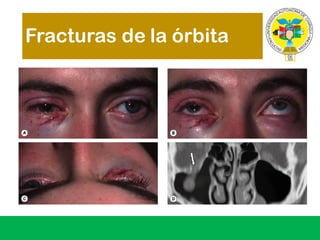 Fracturas de la órbita
 