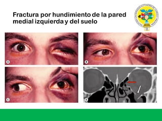 Fractura por hundimiento de la pared
medial izquierda y del suelo
 