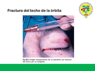 Fractura del techo de la órbita
 