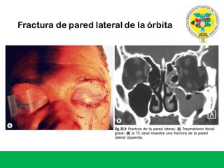 Fractura de pared lateral de la órbita
 