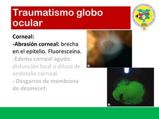 Traumatismo globo
ocular
Corneal:
-Abrasión corneal:	brecha
en	el	epitelio.	Fluoresceína.
-Edema	corneal	agudo:
disfunción local	o	difusa de	
endotelio corneal.	
- Desgarros de	membrana
de	desmecet:	
 