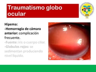 Traumatismo globo
ocular
Hipema:
-Hemorragia de	cámara
anterior:	complicación
frecuente.
-Fuente:	iris	o	cuerpo ciliar.
-Globulos rojos: se	
sedimentan produciendo
nivel líquido.
 