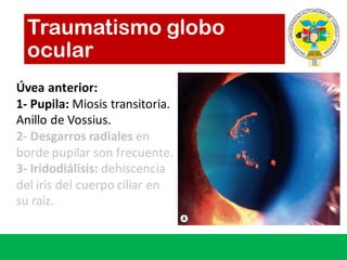 Traumatismo globo
ocular
Úvea anterior:
1- Pupila:	Miosis transitoria.	
Anillo de	Vossius.
2- Desgarros radiales en	
borde pupilar son	frecuente.
3- Iridodiálisis: dehiscencia
del	iris	del	cuerpo ciliar en	
su raíz.	
 