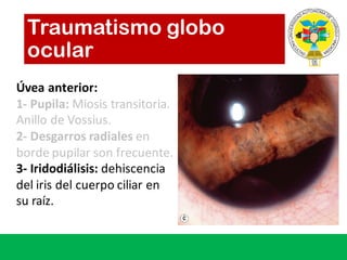 Traumatismo globo
ocular
Úvea anterior:
1- Pupila:	Miosis transitoria.	
Anillo de	Vossius.
2- Desgarros radiales en	
borde pupilar son	frecuente.
3- Iridodiálisis: dehiscencia
del	iris	del	cuerpo ciliar en	
su raíz.	
 