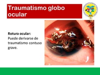 Traumatismo globo
ocular
Rotura ocular:	
Puede derivarse de	
traumatismo contuso
grave.	
 