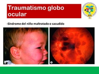 -Síndrome del	niño maltratado o	sacudido
Traumatismo globo
ocular
 
