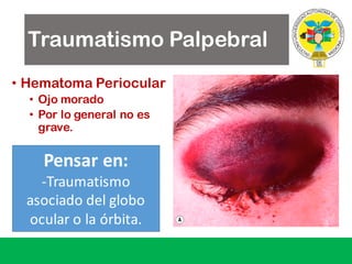 Traumatismo Palpebral
• Hematoma Periocular
• Ojo morado
• Por lo general no es
grave.
Pensar	en:
-Traumatismo	
asociado	del	globo	
ocular	o	la	órbita.
 