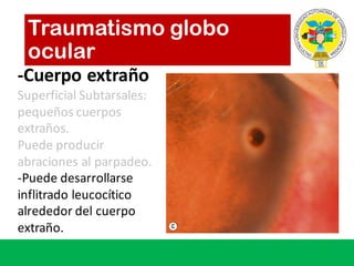 -Cuerpo extraño
Superficial	Subtarsales:	
pequeños cuerpos
extraños.
Puede producir
abraciones al	parpadeo.
-Puede desarrollarse
inflitrado leucocítico
alrededor del	cuerpo
extraño.
Traumatismo globo
ocular
 