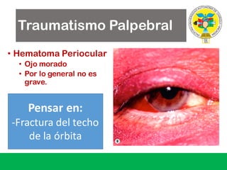 Traumatismo Palpebral
• Hematoma Periocular
• Ojo morado
• Por lo general no es
grave.
Pensar	en:
-Fractura del	techo
de	la	órbita
 