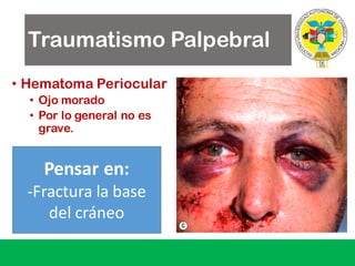 Traumatismo Palpebral
• Hematoma Periocular
• Ojo morado
• Por lo general no es
grave.
Pensar	en:
-Fractura la	base	
del	cráneo
 