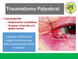 Traumatismo Palpebral
• Laceración
• Exploración cuidadosa
• Evaluar la herida y el
globo ocular
Cualquier defecto por
insignificante que sea,	
debe repararse de	forma	
inmediata.
 
