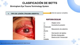 Betts Classification TRAUMATISMO OOCULAR, fracturas de orbita, quemaduras fisicas y quimicas ...
