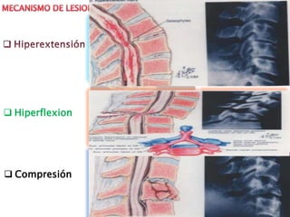  Hiperflexion
 Compresión
 
