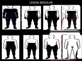 LESION MEDULAR
Daño que se presenta en la
medula espinal y conduce (según
su gravedad) a la perdida de
algunas funciones tanto
sensitivas y/o motoras
 