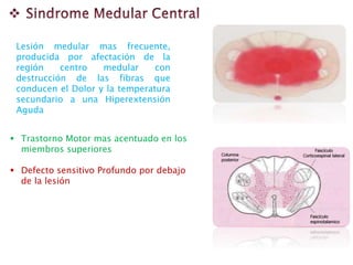 Lesión medular mas frecuente,
producida por afectación de la
región centro medular con
destrucción de las fibras que
conducen el Dolor y la temperatura
secundario a una Hiperextensión
Aguda
 Trastorno Motor mas acentuado en los
miembros superiores
 Defecto sensitivo Profundo por debajo
de la lesión
 