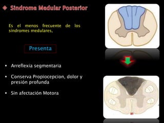 Es el menos frecuente de los
síndromes medulares,
 Arreflexia segmentaria
 Conserva Propiocepcion, dolor y
presión profunda
 Sin afectación Motora
Presenta
 