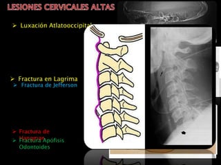  Luxación Atlatooccipital
 Fractura de Jefferson
 Fractura de
Hangman Fractura Apófisis
Odontoides
 Fractura en Lagrima
 