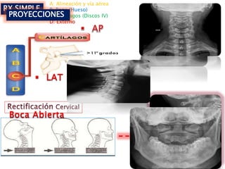 RX SIMPLE
A: Alineación y vía aérea
B: Bone (Hueso)
C: Cartílagos (Discos IV)
D: Externo
PROYECCIONES
 
