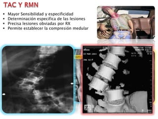  Mayor Sensibilidad y especificidad
 Determinación especifica de las lesiones
 Precisa lesiones obviadas por RX
 Permite establecer la compresión medular
 