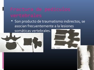 Fractura de pedículos
vertebrales
 Son producto de traumatismo indirectos, se
asocian frecuentemente a la lesiones
somáticas vertebrales.
 
